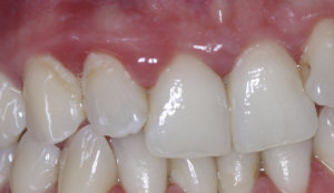 Jak obnovit dásně